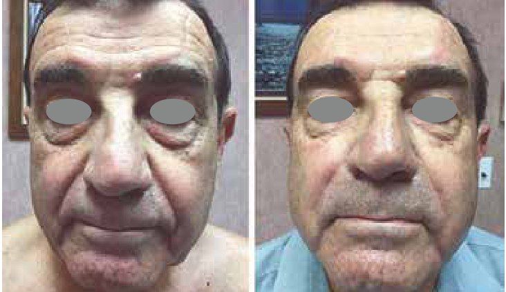 Fotona 4D Men: чоловіче обличчя до і після процедури