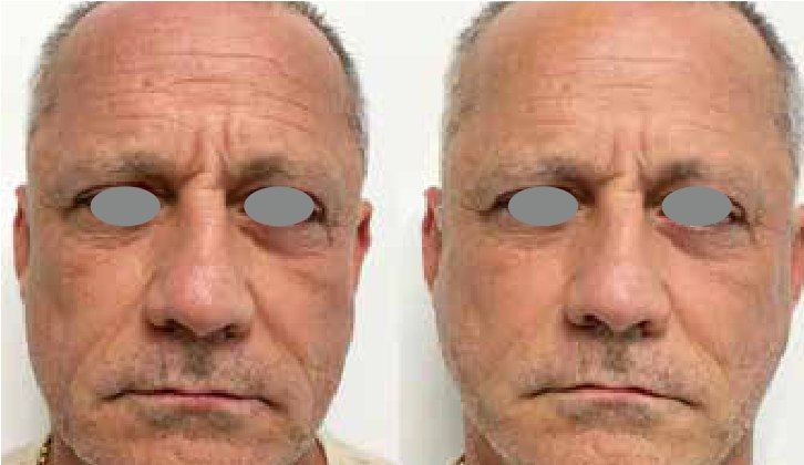 Fotona 4D Men: результат омолодження до і після